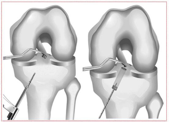 Thiết bị hỗ trợ khớp gối khi bị đứt dây chằng chéo trước