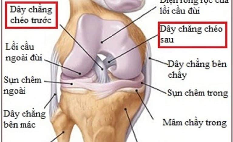 Biến chứng từ đứt dây chằng chéo trước