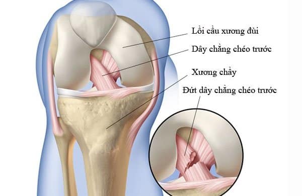 Đứt dây chằng đầu gối là gì?