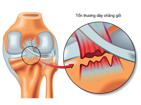 Nhận biết triệu chứng đứt dây chằng đầu gối