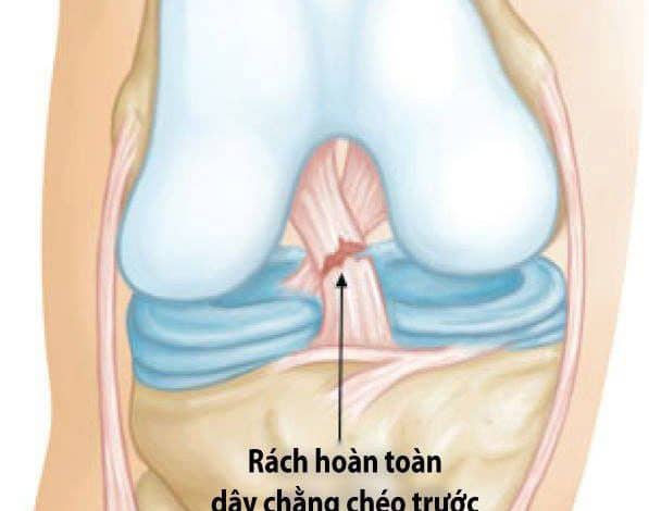 đứt dây chằng chéo trước