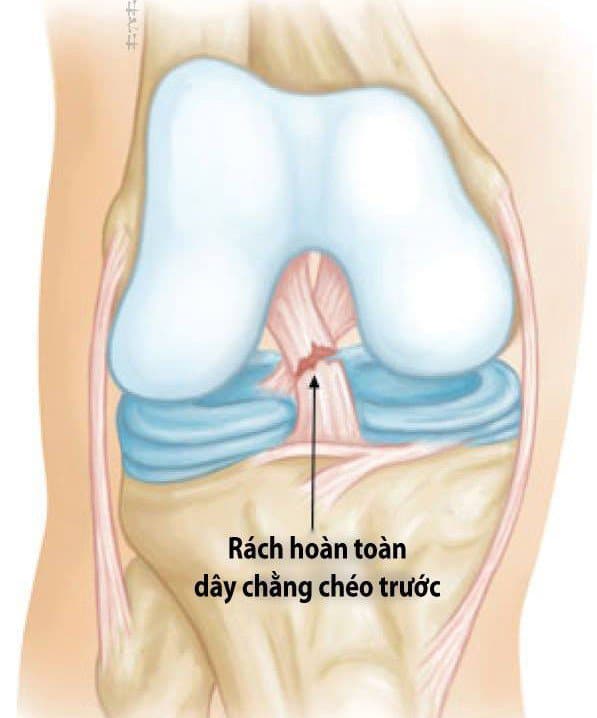 đứt dây chằng chéo trước