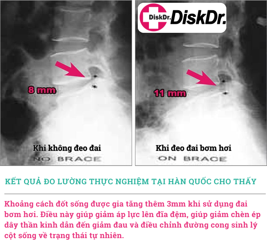 Khoảng cách đốt sống gia tăng khi sử dụng đai lưng DiskDr