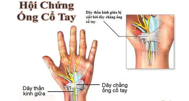 Hội chứng ống cổ tay là tình trạng các mô, cơ, xương chèn ép lên dây thần kỳ giữa trong đường hầm cổ tay