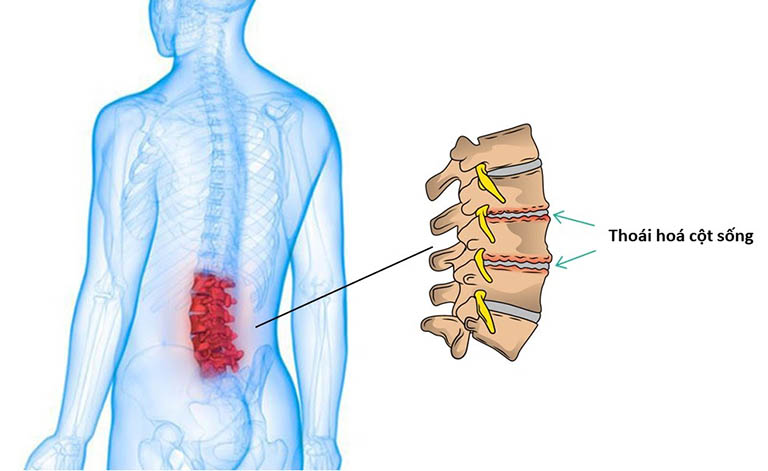 ệnh thoái hóa cột sống ảnh hưởng nghiêm trọng đến cuộc sống sinh hoạt của người bệnh