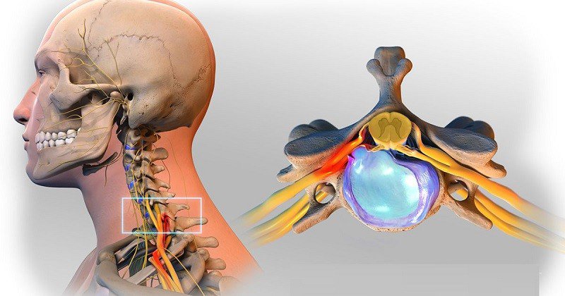 Top 10 bài tập thoát vị đĩa đệm cổ hiệu quả tại nhà