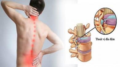 Thoát vị đĩa đệm thắt lưng - Nguyên nhân và cách điều trị dứt điểm