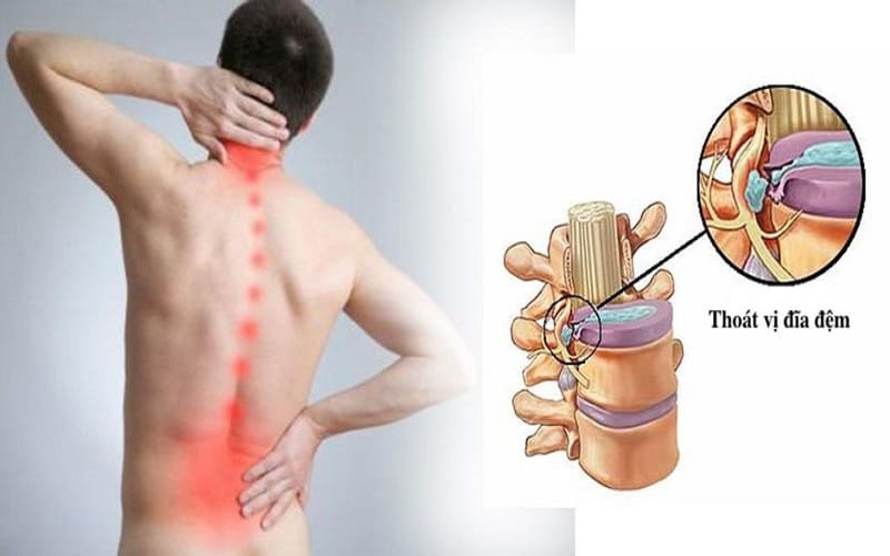 Thoát vị đĩa đệm thắt lưng - Nguyên nhân và cách điều trị dứt điểm