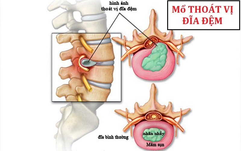 Những biến chứng có thể gặp phải sau mổ thoát vị đĩa đệm