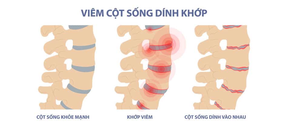 Viêm cột sống dính khớp là nguyên nhân gây đau cổ vai gáy