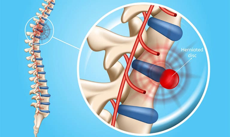 Dây thần kinh L5 bị lệch ra khỏi đốt sống L4 L5 và chi phối các cơ đùi và đầu gối, bên hông