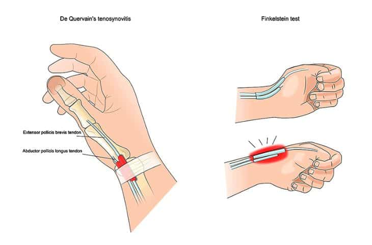 Hội chứng De Quervain