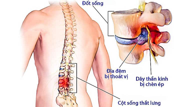 Thoát vị đĩa đệm cột sống thắt lưng