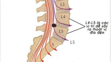 Thoát vị đĩa đệm L4 L5 là gì?