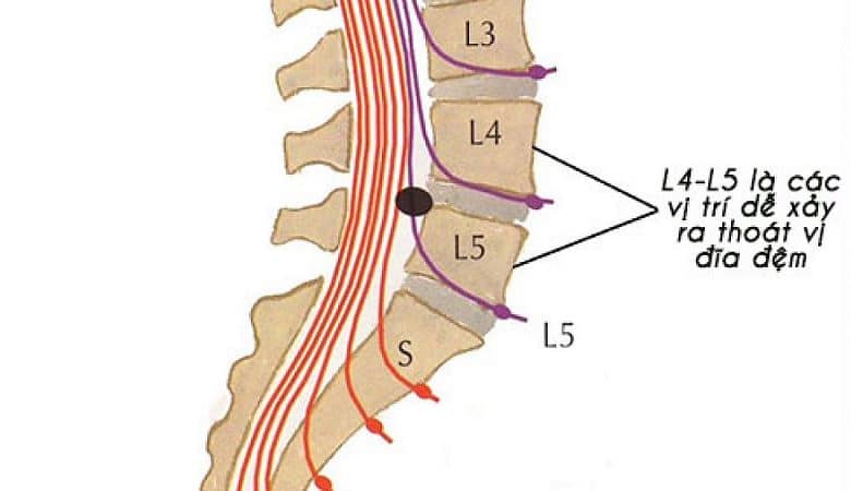 Thoát vị đĩa đệm L4 L5 là gì?