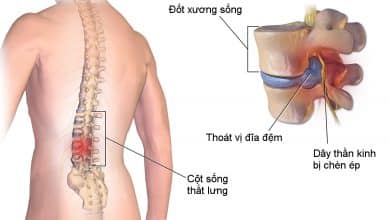 Thoát vị đĩa đệm đốt sống lưng