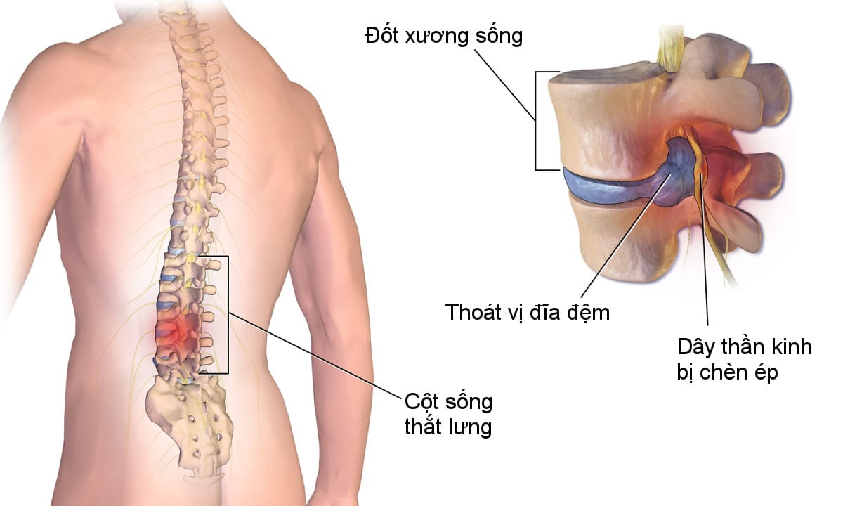 Thoát vị đĩa đệm đốt sống lưng