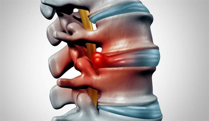 Thoát vị đĩa đệm L4 L5 gây đau lưng, đau vùng mông, hông, đùi, cẳng chân hoặc bàn chân.