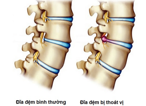 Thoát vị đĩa đệm có thể xảy ra ở bất kỳ vị trí nào trên đốt sống lưng, cột sống lưng nhưng phổ biến nhất là ở vùng lưng dưới
