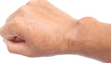 U khớp cổ tay - Nguyên nhân và các điều trị hiệu quả