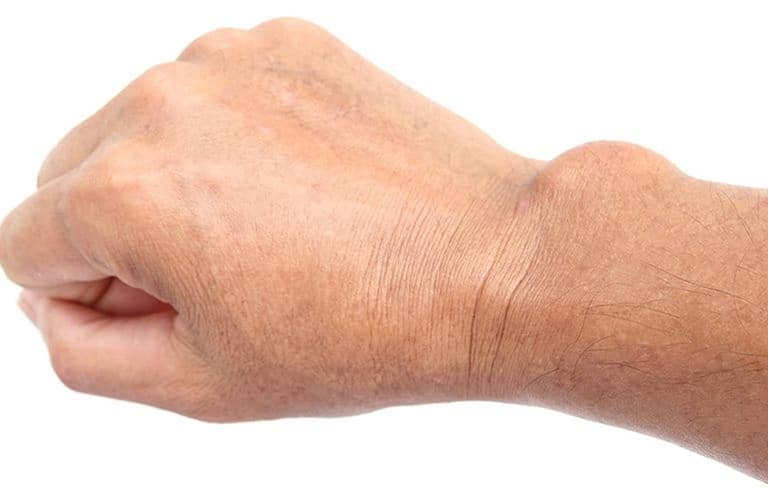 U khớp cổ tay - Nguyên nhân và các điều trị hiệu quả