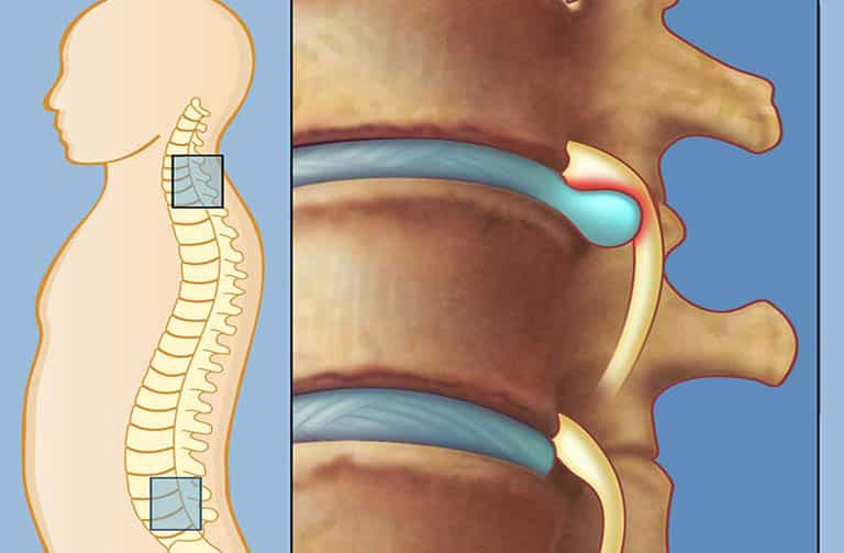 Thoát vị đĩa đệm đa tầng là căn bệnh nghiêm trọng bởi nhiều vị trí đĩa đệm bị tổn thương đồng thời.