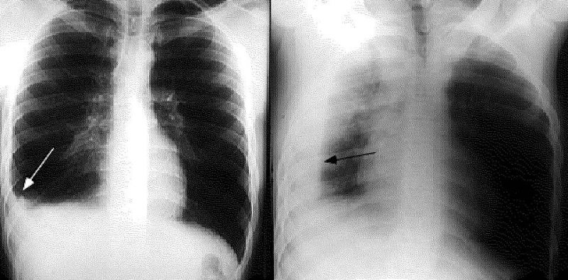 Bệnh viêm màng phổi 