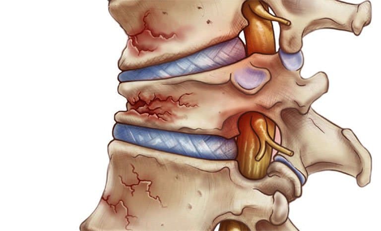 Gãy xương cột sống