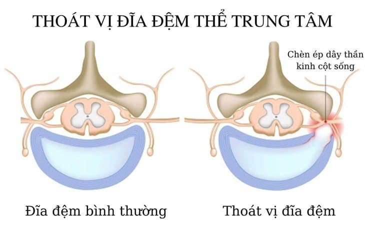 Thoát vị đĩa đệm thể trung tâm