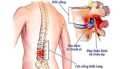 Thoát vị đĩa đệm thể trung tâm: nguyên nhân, liệu pháp điều trị và cách phòng ngừa